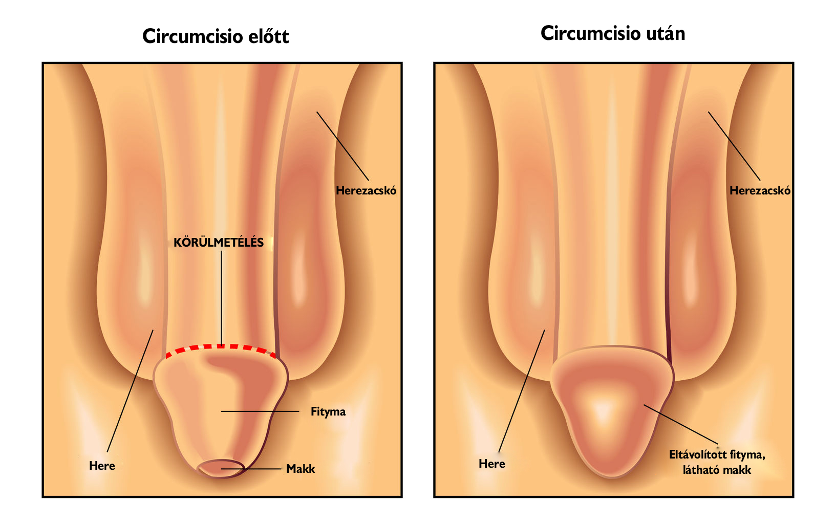 Urológiai műtét - Circumcisio - Körüllmetélés