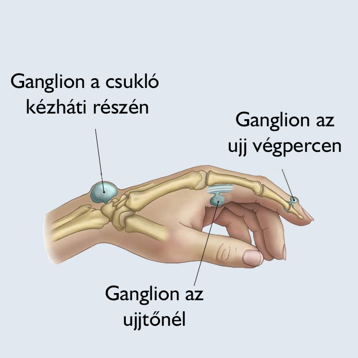 Ganglionok előfordulása a kézen