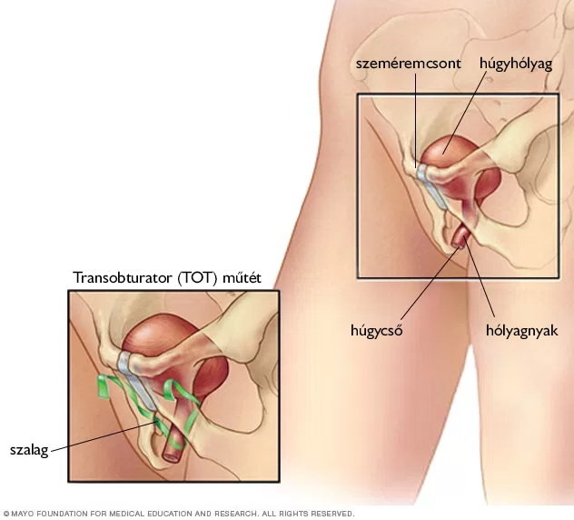 Anti inkontinencia (TOT) műtét